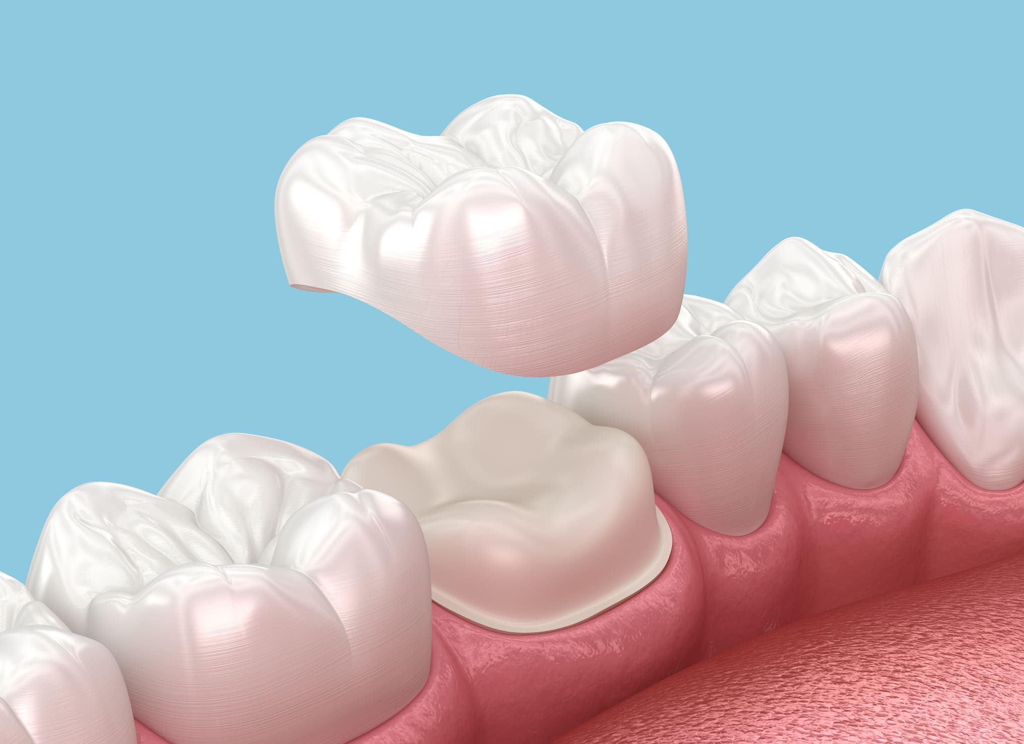 Dental Crown Columbia SC