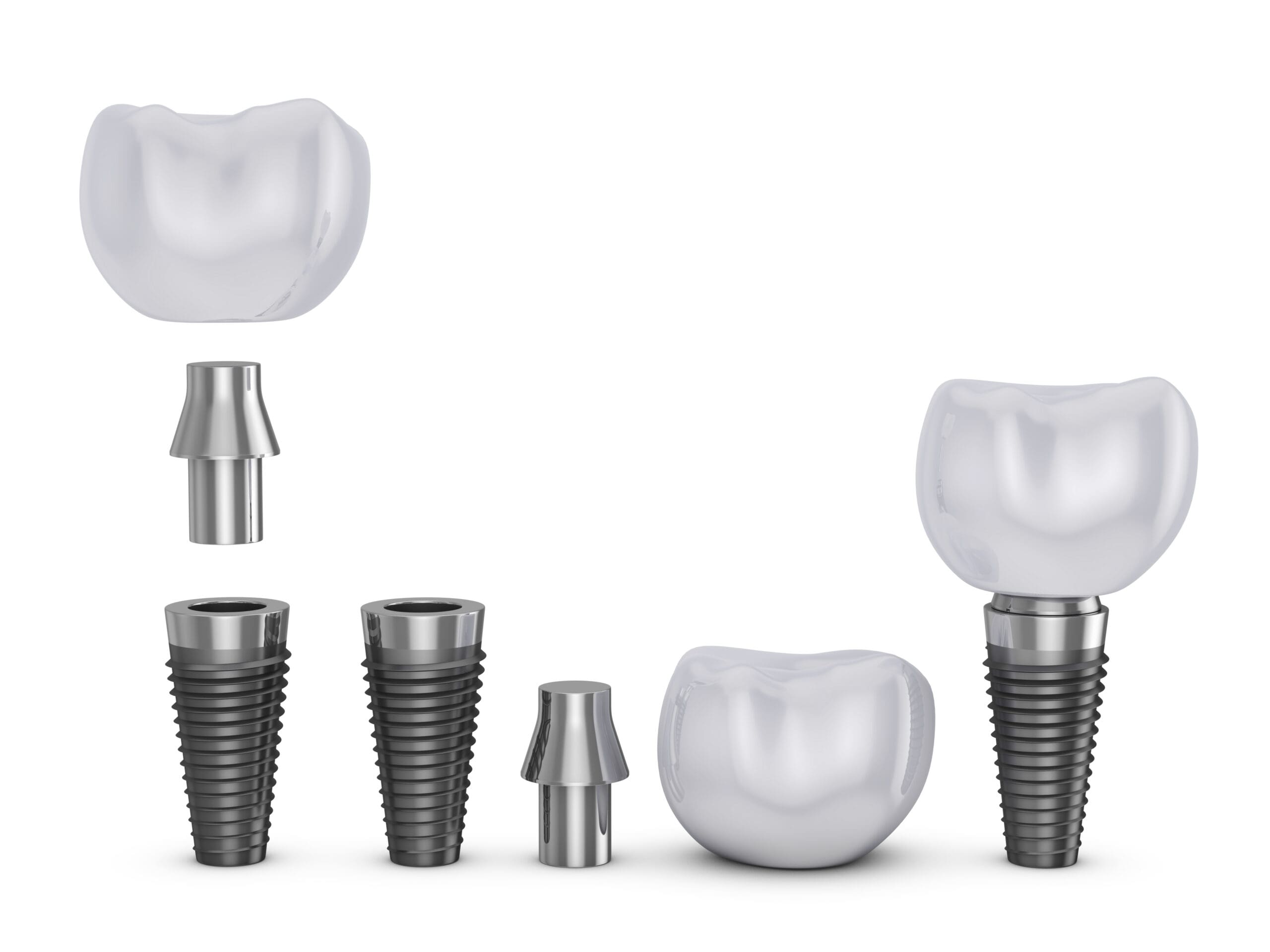 Dental Implants Columbia SC