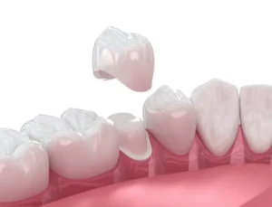How to Make a Dental Crown Last in Columbia, SC