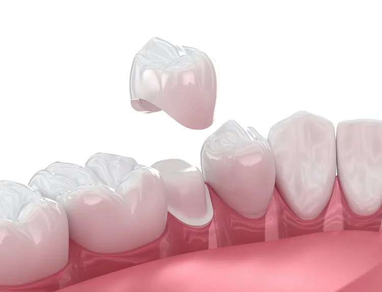 How to Make a Dental Crown Last in Columbia, SC